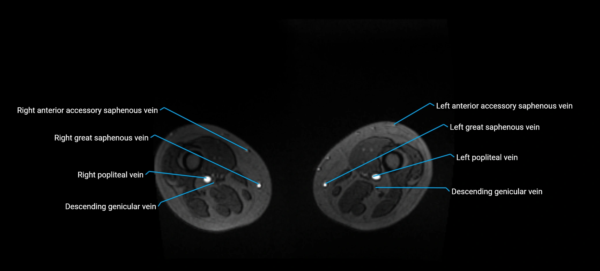 MRV abdomen pelvis & lower limb axial cross sectional anatomy labelled MRI image 317.webp
